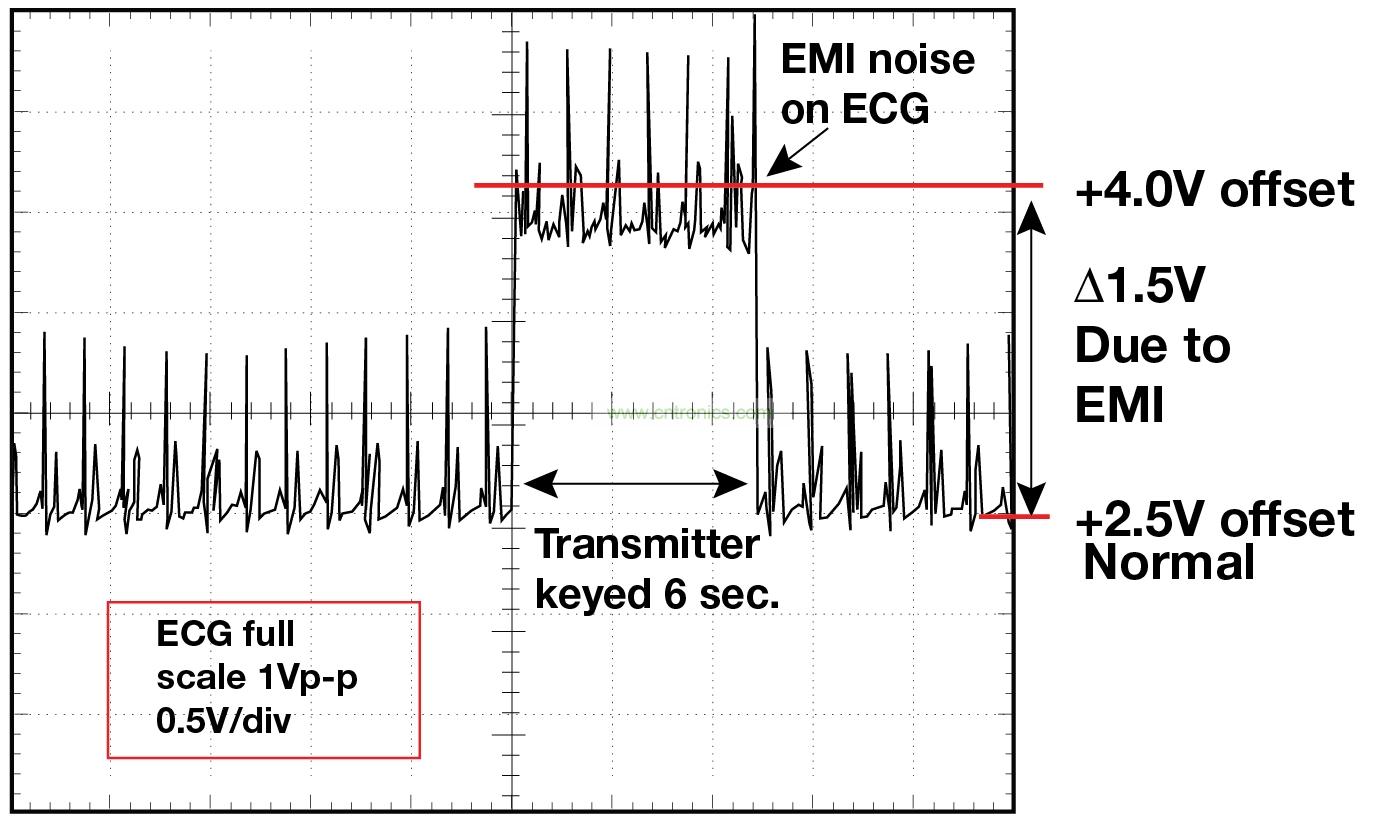 图 1 1.5 英尺以外的发射器(f = 470 MHz, P= 0.5W)开启和关闭时 ECG 诊断设备的心脏检查结果